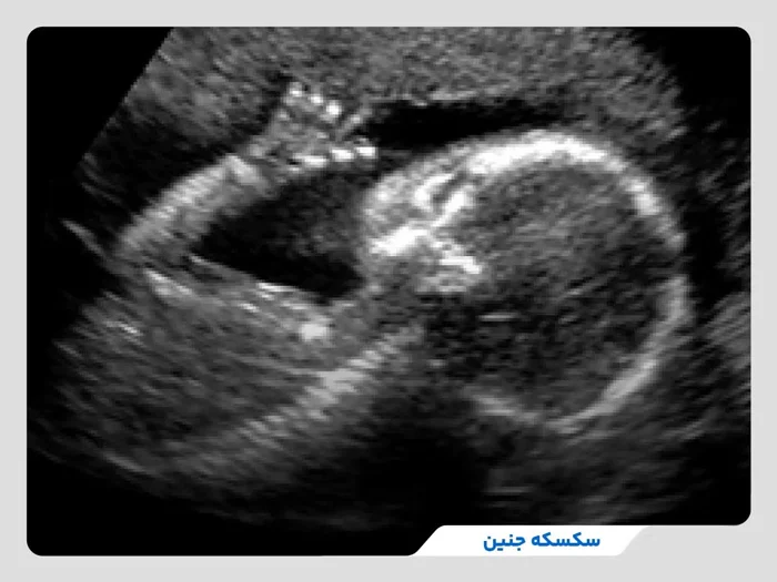 دلایل سکسکه‌کردن جنین در رحم مادر چیست و چگونه احساس میشود؟