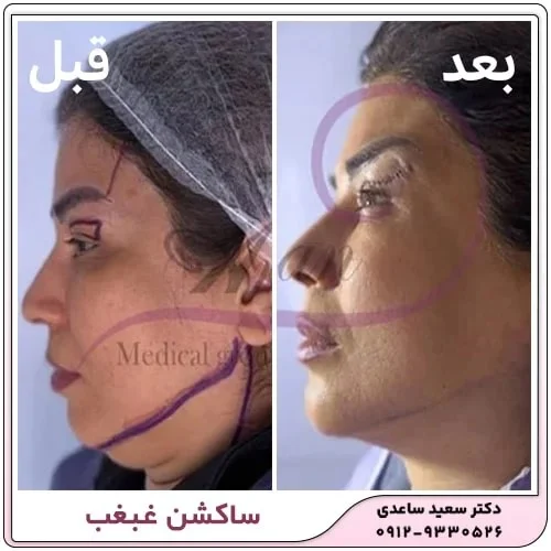 چگونه غبغب را از بین ببریم؟