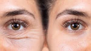 چگونه بلفاروپلاستی را از بین ببریم؟ بررسی روش ها و جایگزین ها