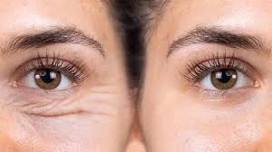 چگونه بلفاروپلاستی را از بین ببریم؟ بررسی روش ها و جایگزین ها